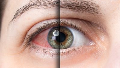 Sürekli gözünü ovuşturanlar dikkat: Kornea nakli gerekebilir!